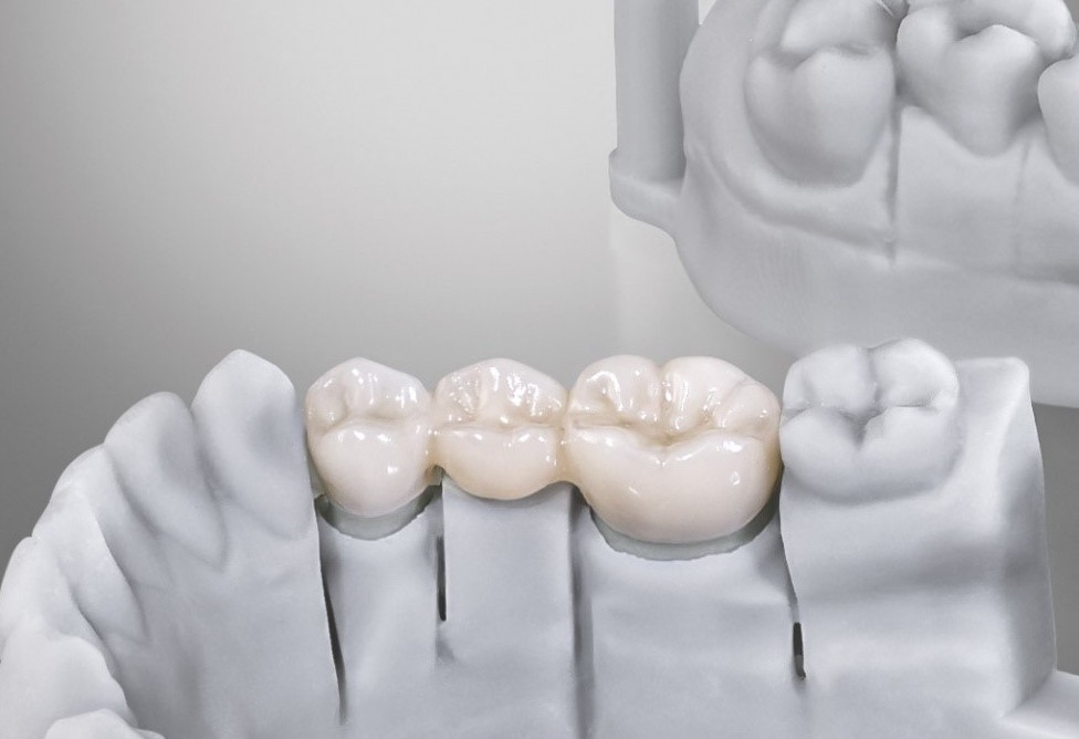 3D打印牙齿修复.jpg